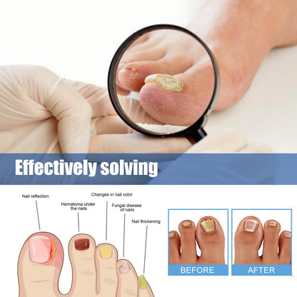 Nail repair patches for toenail fungus and ingrown nails(60 pieces)